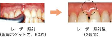 八王子市大和田町の歯医者、はら歯科医院のレーザー治療