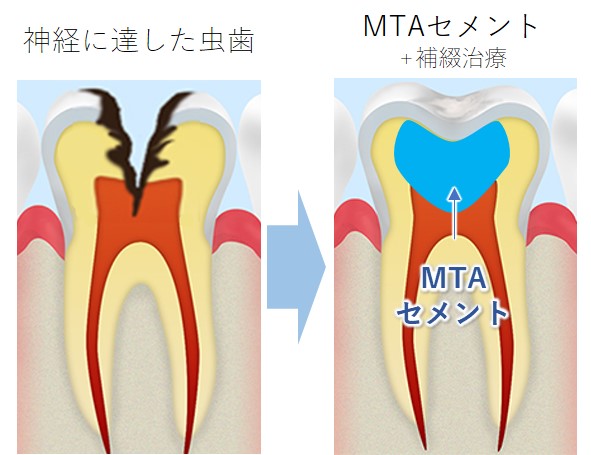 八王子市大和田町の歯医者、はら歯科医院のMTAセメント