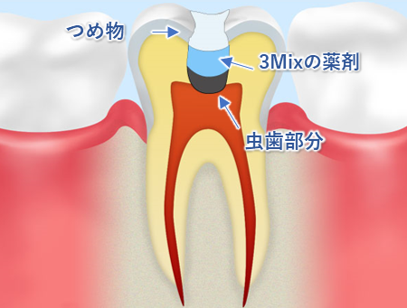 八王子市大和田町の歯医者、はら歯科医院の3Mix-MP法