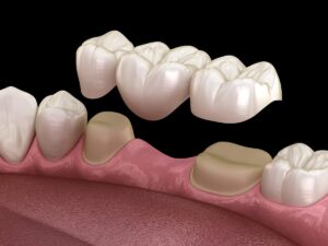 八王子市大和田町の歯医者、はら歯科医院で保険治療でも「白い歯」に。ブリッジ