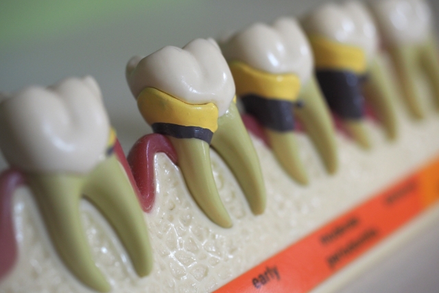 八王子市大和田町の歯医者、はら歯科医院の歯周病治療
