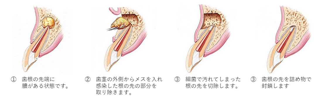 八王子市大和田町の歯医者、はら歯科医院で歯根端切除術